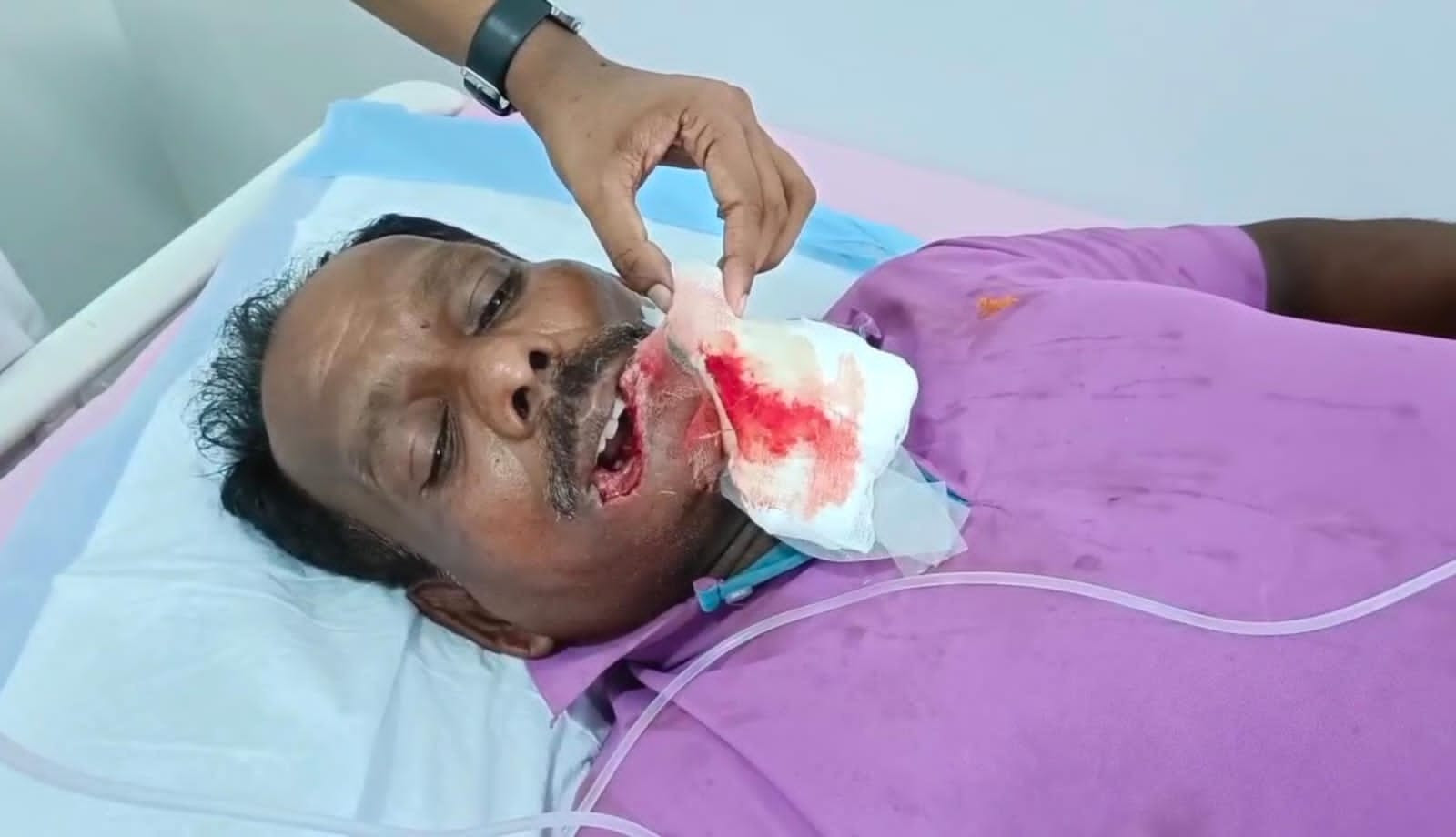 உதட்டை கடித்து, துண்டித்து எடுத்துச் சென்ற இராணுவ வீரர்...! பரபரப்பு...!